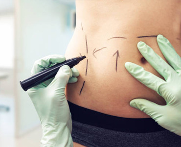lipo