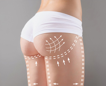 lipofilling-glutei-1